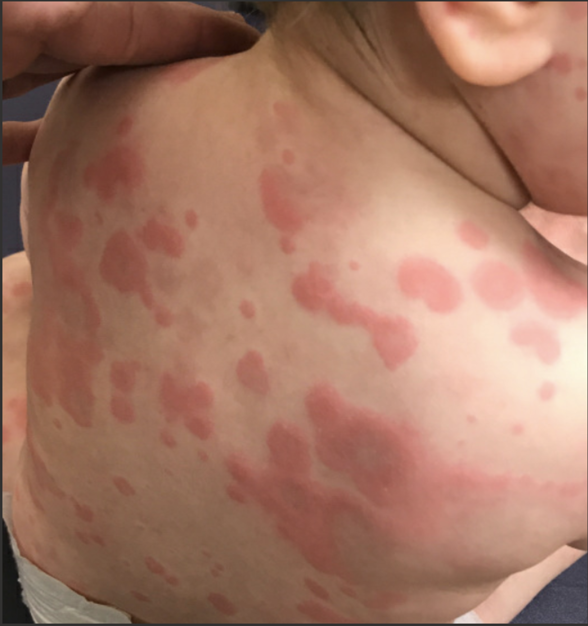 4/25/23: PEM Case of the week