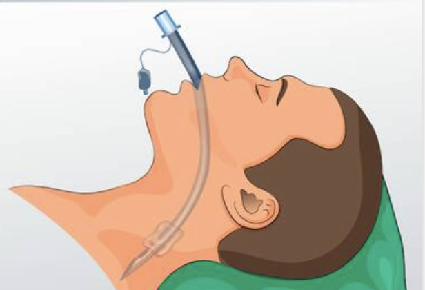 6/13/23: POCUS guided ETT placement